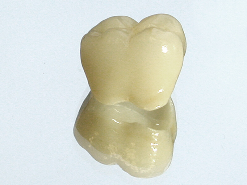 Zahnkronen und Zahnersatz